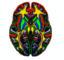 MRI Scan